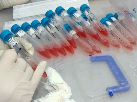 Yên Bái: Nhân viên khách sạn dương tính SARS-CoV-2, lây từ chuyên gia Ấn Độ